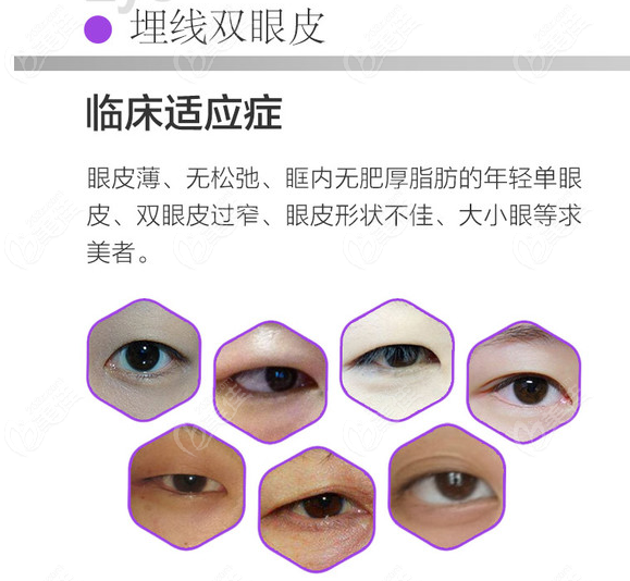  The price of eyes is appropriate in the ranking list of regular hospitals with good double eyelids in Yingtan