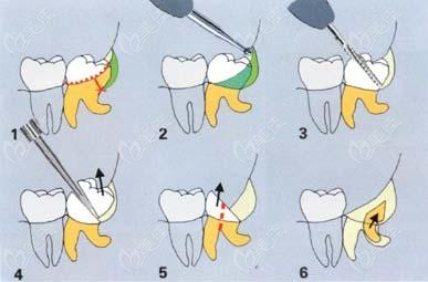  How much is one wisdom tooth extracted in Nantong