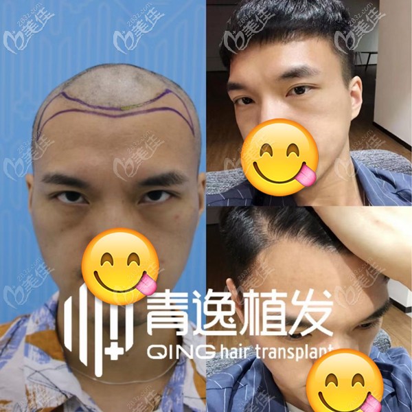  Does Shenzhen Qingyi (Qingyi) Hair Transplantation Work Well