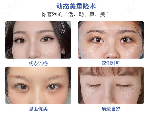  Doctor Wang Zhidong from Shenzhen has a reliable double eyelid technique