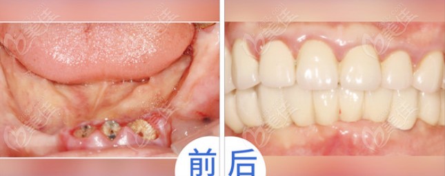  The dental implant in Fengze District, Quanzhou is not only technically good