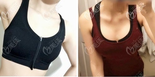  How much is breast augmentation with Wuhan Ren'ai Shiguang prosthesis