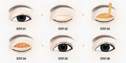  How about Dr. Sun Feng's double eyelid cutting and eye repair