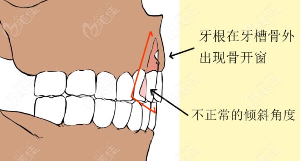 正畸形成骨开窗怎么治疗