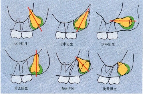  How much is one wisdom tooth extracted in Nantong