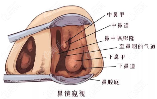 假体隆鼻鼻尖发白要取出假体吗