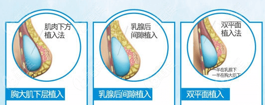  Ask which one in Changsha is more skilled in doing imported breast augmentation prosthesis, good Yamei or star plastic surgery