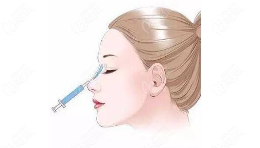  It turns out that how much it costs to make a nose at Pingdingshan depends on whether you make a prosthesis or inject hyaluronic acid for augmentation rhinoplasty