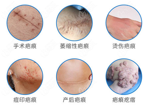  Which hospital is better for Xiamen laser scar removal