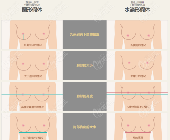 从术后评价和手感上对比进口韩国蓓菈假体和德国宝俪假体哪个好