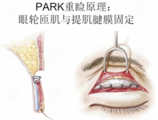  Which is better, Medusa's double eyelids or park's double eyelids