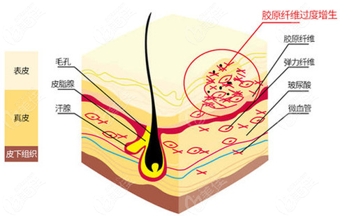  Which hospital is better for Xiamen laser scar removal