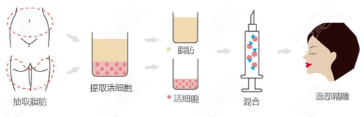  What's the price of autologous fat facial filling in South Korea