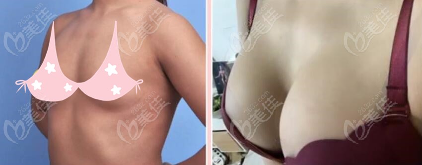  Price list of breast augmentation surgery in South Korea