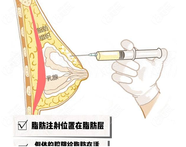  Which is better, prosthetic breast augmentation or autologous fat breast augmentation