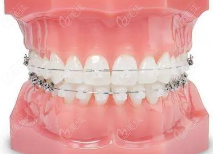  How much does Yiyang orthodontics cost