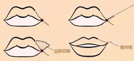  How about Doctor Sha in Dalian doing plastic surgery to lift the corners of the mouth