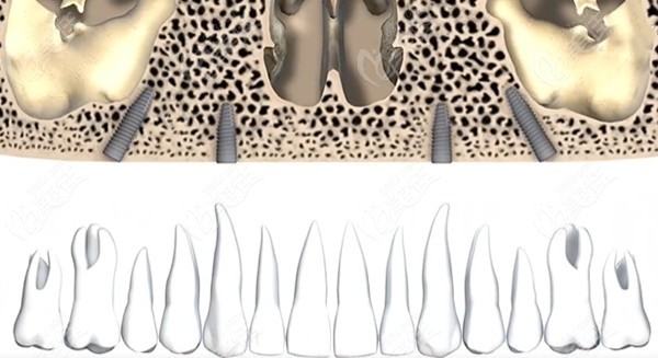  Detailed steps for declassifying allon4 and allon6 implant teeth