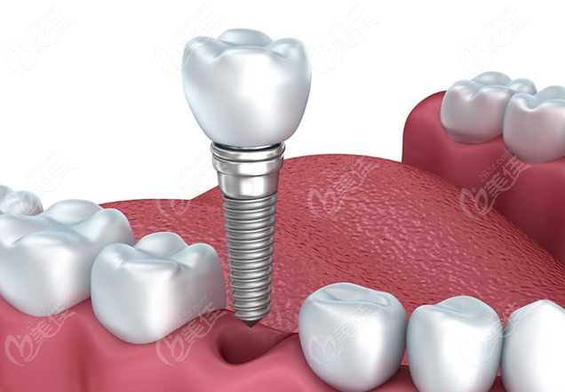  2022 Price List of Implant Teeth in Shenzhen