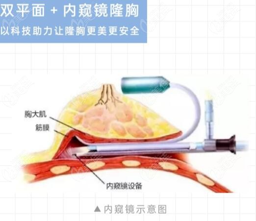  Doctor Yang Daping's endoscopic breast augmentation technique and aesthetics are very good