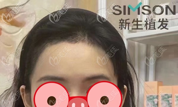  How about hair transplant in Kunming Xinsheng