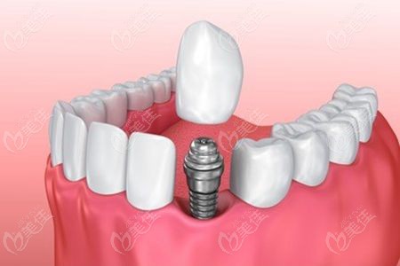 单颗牙齿缺失是做种植牙还是烤全瓷牙
