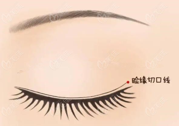  Rapid nano double eyelid is not the traditional full cut double eyelid