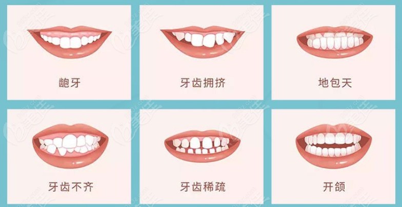  How much is the invisible tooth correction in Wenzhou