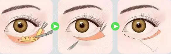  Hangzhou Shiguang Plastic Eye Bag Removal is very good