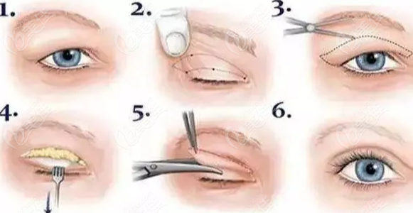  How about Qingdao Yimei Tiancheng Baihuabao for double eyelid surgery