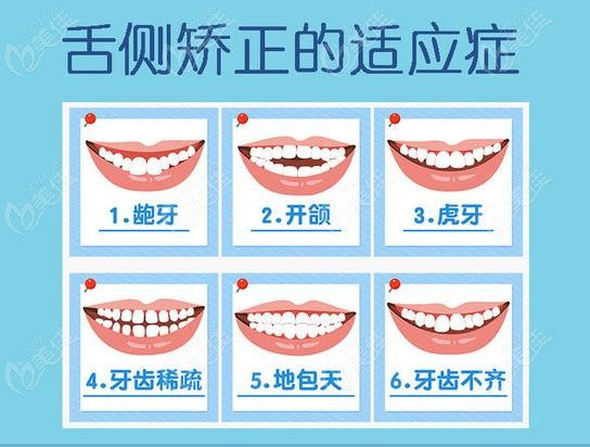 舌侧隐形矫正可以矫治龅牙吗