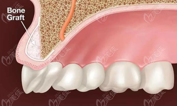 探究种牙的骨粉价格为什么贵