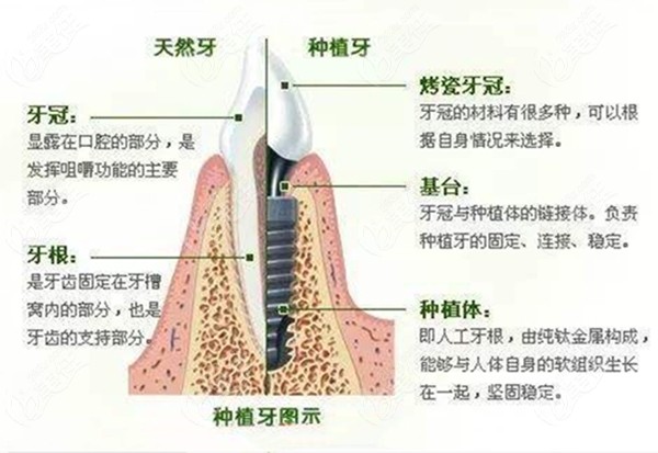 日本种牙好还是国内好