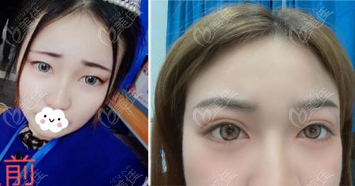  Yuncheng full cut eyelid repair