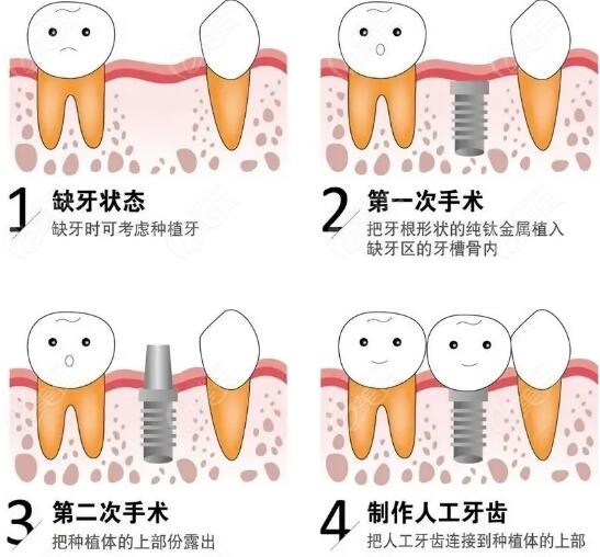 讲解我种牙5年后的真诚感受