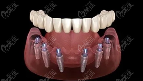  Detailed steps for declassifying allon4 and allon6 implant teeth