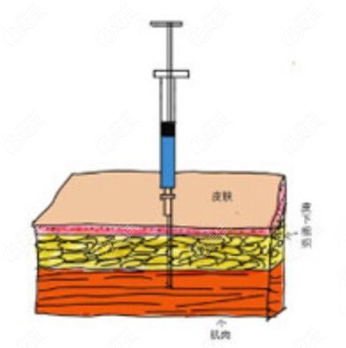  How about Baoding Yuemei doing facial embedding and lifting