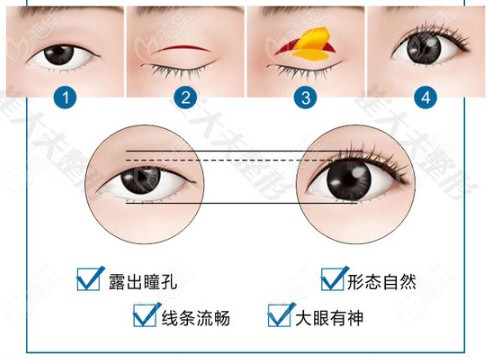  How about Dr. Cui from Lanzhou, Shi Yunhong, doing double eyelid surgery