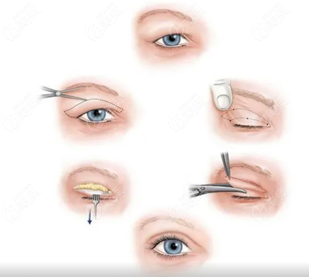  How about Dr. Sun Feng's double eyelid cutting and eye repair