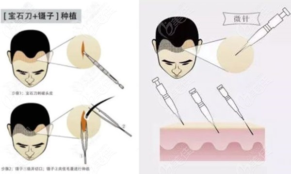  Where is the cheap hair transplant in Zhengzhou? The technology is good