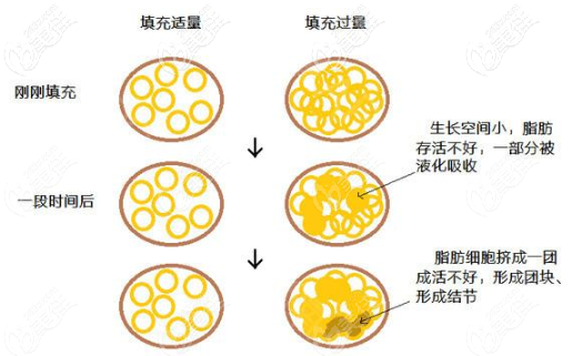  The risks of causing too much pain in autologous fat breast augmentation are