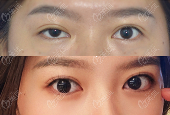  Recommend Nanchang to you as a doctor who has repaired the double eyelids