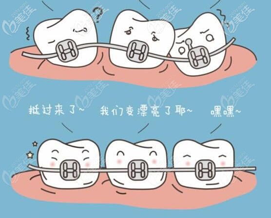 3M自锁金属正畸托槽有几种型号