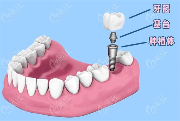  Price of dental implants in Liaocheng Stomatological Hospital