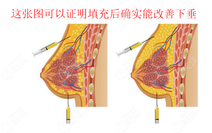  Postpartum sagging and shriveled chest, effective for autologous fat filling