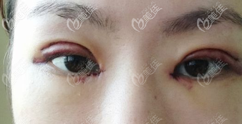  Can the blackened upper eyelid recover after three months of double eyelid surgery