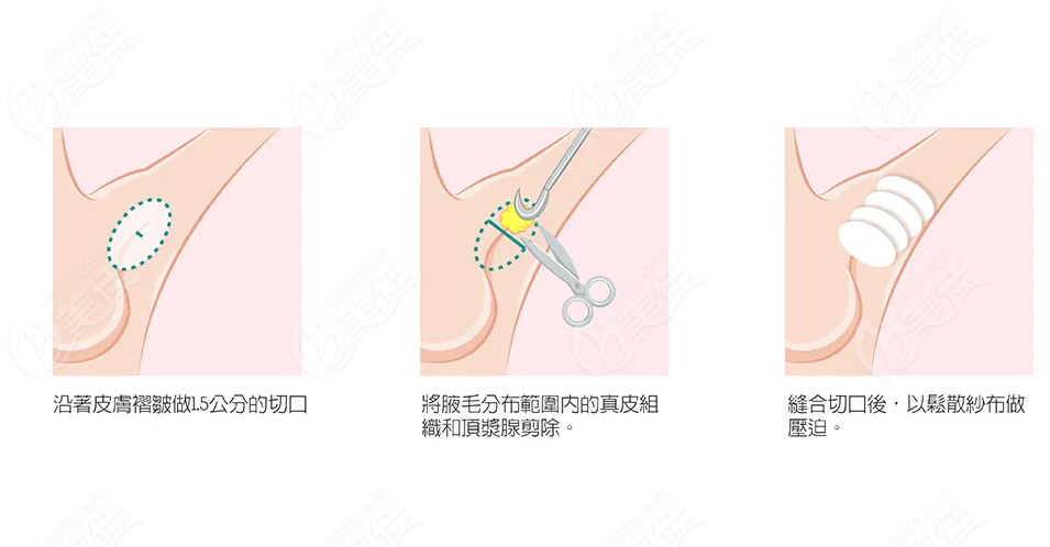  How about removing armpit odor in Chengdu West District Hospital