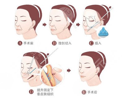  Beijing Badachu Plastic Surgery Hospital How about skin lifting and wrinkle removal? How much is it