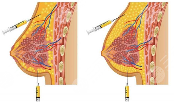  How about breast augmentation in the Second People's Hospital of Guangdong Province