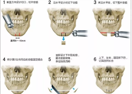  Which doctor is better for Beijing to unite with Rigo to make mandibular angle and zygomatic bone